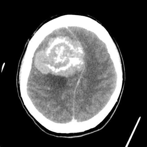 Parafalcine Atypical Meningioma Image