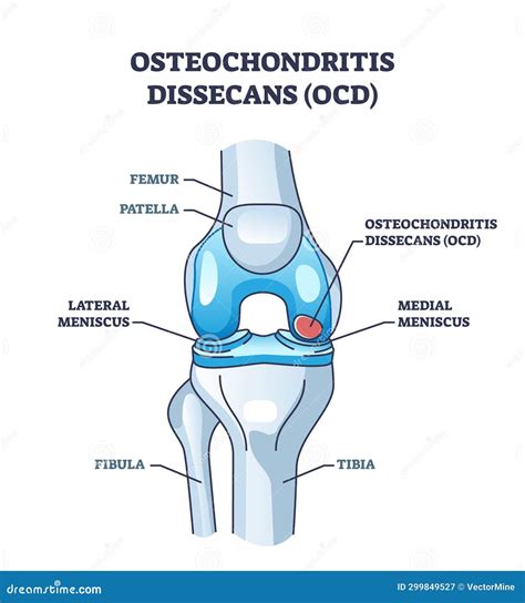 Osteochondritis Dissecans Or Ocd Bone And Cartilage Condition Outline