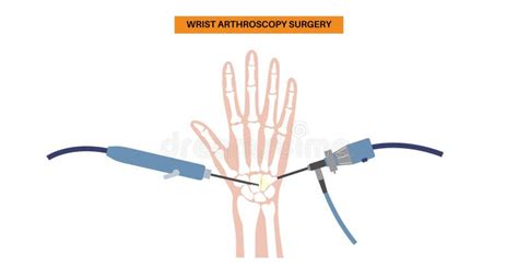 Wrist Arthroscopy Surgery Stock Illustration Illustration Of