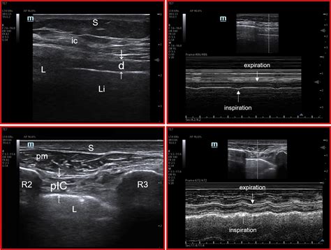 Oesophageal Pressure And Respiratory Muscle Ultrasonographic