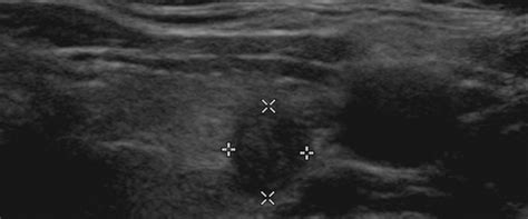 What thyroid cancer looks like on ultrasound?