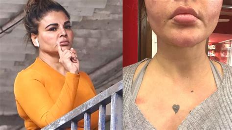 Rakhi Sawant Shares Pictures Of Her Injuries Warns Her Brother Hindu