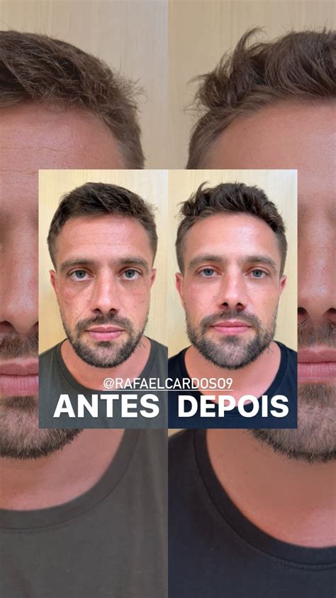 Foto O Antes E Depois De Rafael Cardoso Purepeople