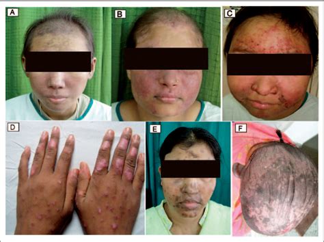 Figure 1 From The Study Of Cutaneous Lupus Erythematosus Disease Area