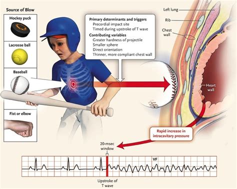 Comotio-Cordis - REBEL EM - Emergency Medicine Blog