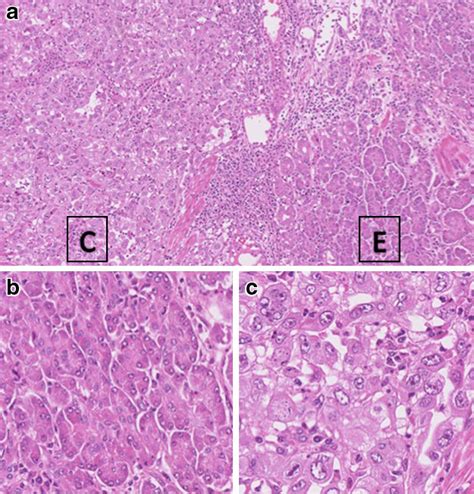 A Microscopic Image Of The Tumor Ectopic Pancreatic Tissue Showed