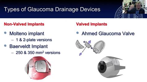 Glaucoma Drainage Device Surgery Dr Brandt Youtube