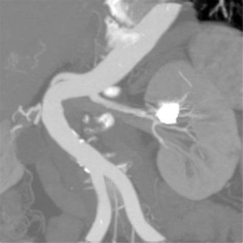 Selective Left Renal Artery Angiography After Coil Deployment And