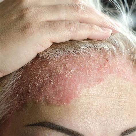 Scalp Psoriasis Home Remedies And Tips For Relief Forces Of Nature Medicine