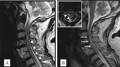 Figure From Spontaneous Cervical Epidural Hematoma Treated By The