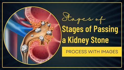 Stages Of Passing A Kidney Stone Kidney Stone Passing Process With