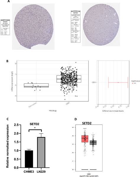 SETD2 Expression Is Elevated In Human Gliomas A SETD2 Expression In