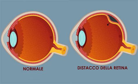 Distacco Della Retina Sintomi Cause Trattamento E Prevenzione