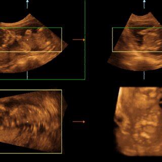 Multiplanar Three Dimensional Ultrasound D Us Image Of Fetal