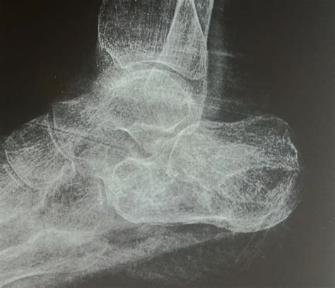 Minimally Invasive K-Wire Fixation for Intra-Articular Calcaneal Fractures