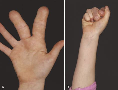 Deformities of the Hand and Fingers | Musculoskeletal Key