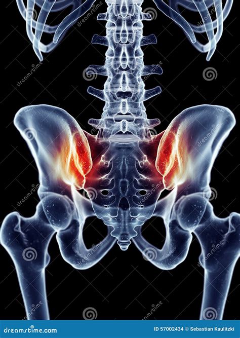 Painful Iliosacral Joint Stock Illustration | CartoonDealer.com #57002431