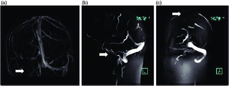 Brain Magnetic Resonance Venography Mrv Revealed Right Transverse