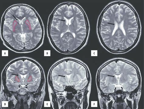 Segmentation Method Example For Caudate Nucleus On A T 2 Weighted Mri