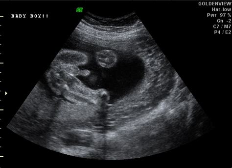 Using 2D and 3D Ultrasound to Determine the Gender of a Baby in the Womb - Goldenview Ultrasound