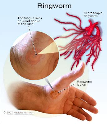 Worms Bracelet (Ringworm) - Sign Symptoms Definition - Your Health