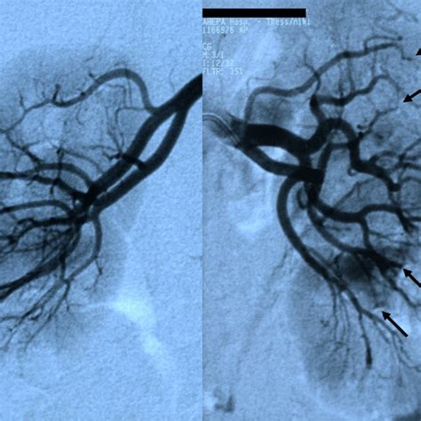 Catheter Directed Right And Left Renal Angiography Shows Stenoses And