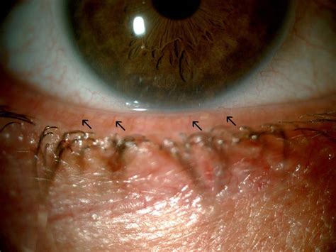 Meibomian Gland Cyst