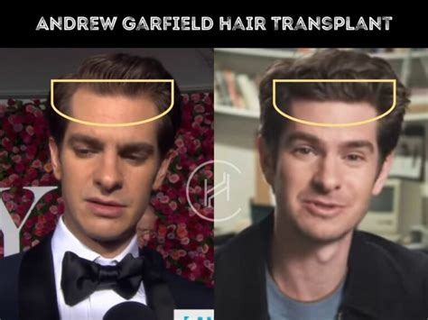 Andrew Garfield Hair Transplant Hair Loss And Technical Analysis