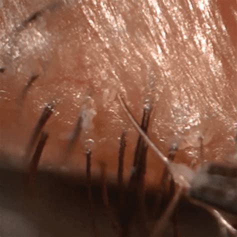 Demodex Eyelash Mites