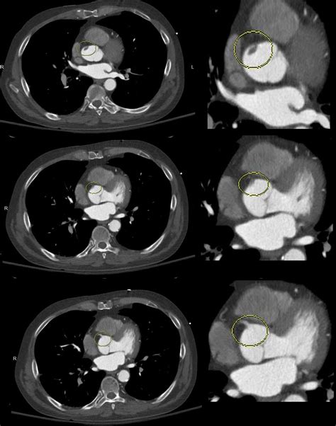 091h Thrombus At The Right Coronary Artery Ostium Rca Heart