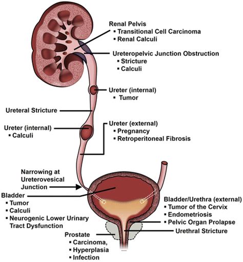 Ureteral Stents Nephrostomy Tubes And Urethral Dilators Abdominal Key