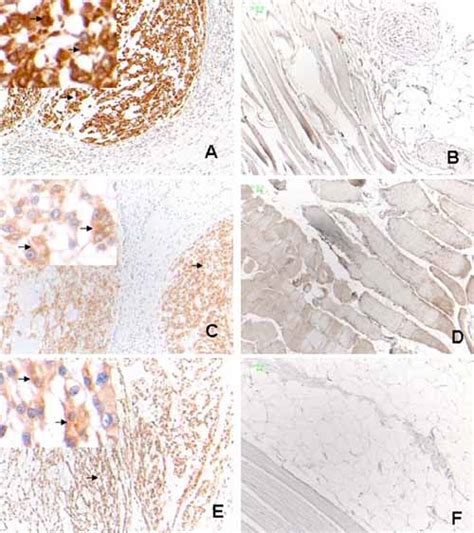 Immunohistochemical Staining Of Chordomas And Adjacent Normal Tissues