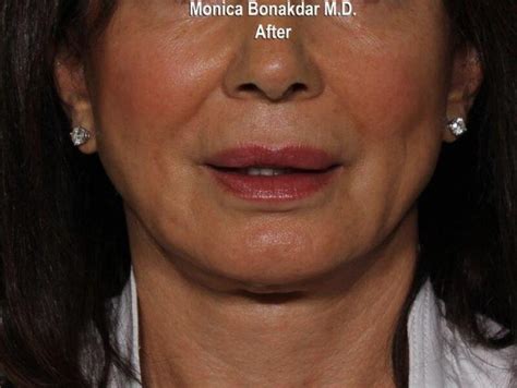 Lip Line Correction Before And After Newport Beach Bonakdar