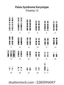 Down Syndrome Trisomy 21 Human Karyotype Stock Illustration 2284653481