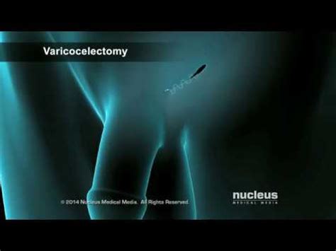 Cirug A Para Varicocele Youtube