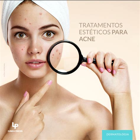 Tratamentos estéticos para acne Dr Lucas Penchel