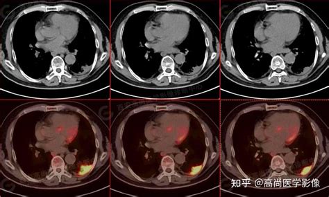 PET CT病例肺鳞癌5例高尚医学影像 知乎