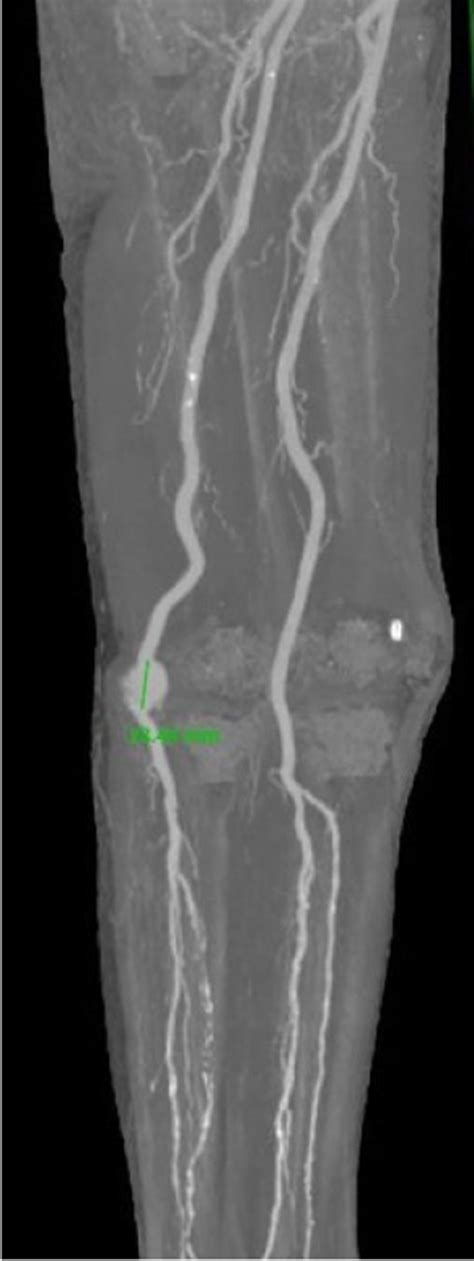 Open Repair With Resection And Reimplantation For Popliteal Artery