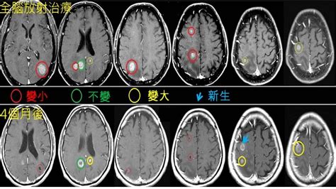 治療方式開顱放射加馬刀