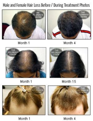 thinned out hair before and after - Maurine Blackburn