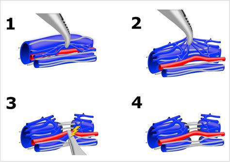 Laparoscopic lymphatic and artery sparing microsurgical varicocelectomy ...
