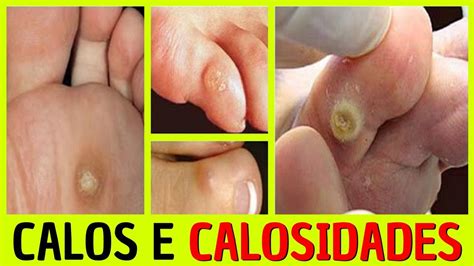 Podologia Calos E Calosidades Curso De Podologia Unha Encravada