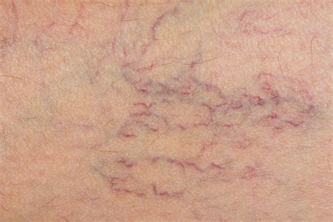 Varicose Veins & Spider Veins: Causes & Treatment | Live Science