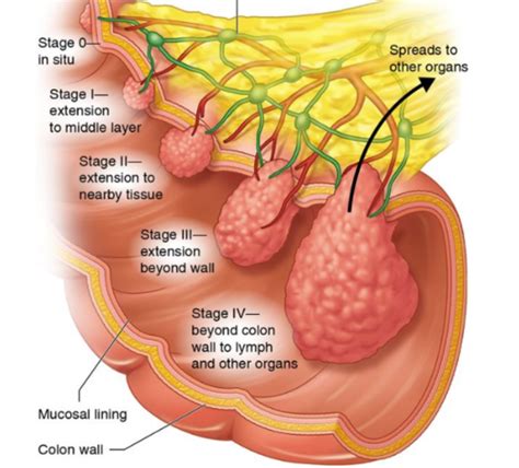 Colon Colorectal Cancer Flashcards Quizlet