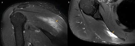 A Partial Tear Of The Infraspinatus Muscle Journal Of Orthopaedic