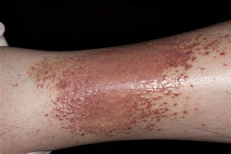 eczema on leg - pictures, photos