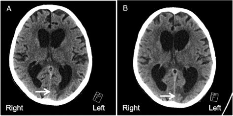 Brain Computerized Tomography Ct Scan Comparison Displaying The