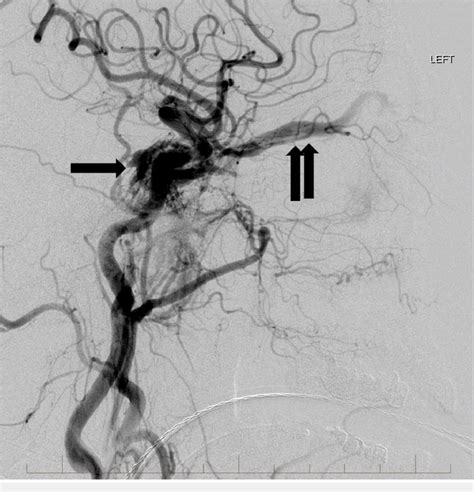 Lateral View From A Left Common Carotid Artery Angiogram Showing The