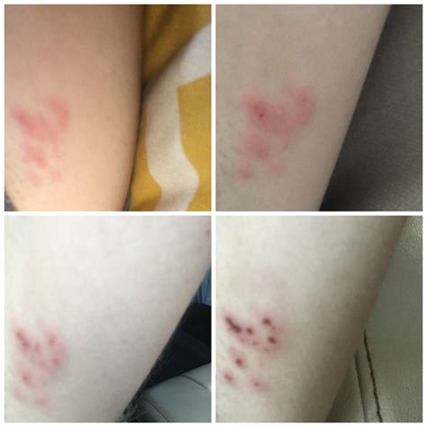 That time I got Shingles from stress
