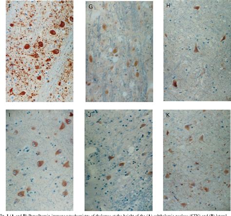 Figure 1 From Clinical Findings In Sporadic Creutzfeldt Jakob Disease